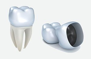 Dental Crowns | Dentist Warner