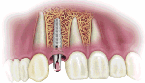 dental implants warner