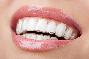 Invisalign in warner