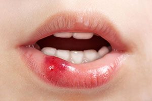 Soft Tissue Injuries in the Mouth | Dentist Warner