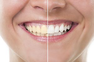 teeth whitening warner