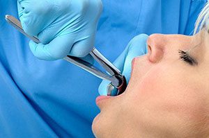 Tooth Extractions | Dentist Warner