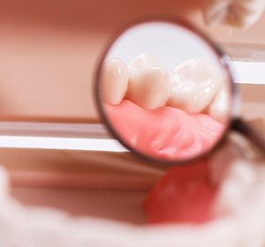 Tooth Fillings | Dentist Warner