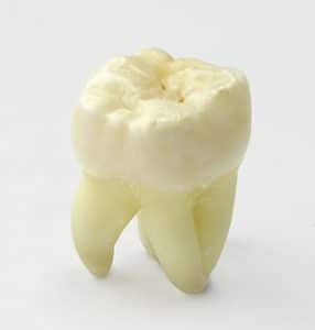 Wisdom Tooth Removal | Dentist Warner