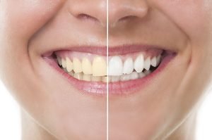 3 Simple Ways to Naturally Whiten Your Teeth