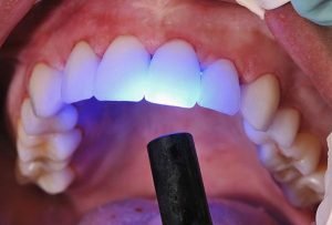 Warner Lakes Dental Dental Bonding | Dentist Warner