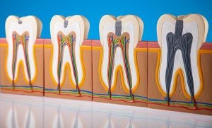 Warner Lakes Dental Tooth Decay | Dentist Warner