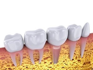 Dental Implants Your Long-lived Permanent Tooth Replacement | Dentist Warner