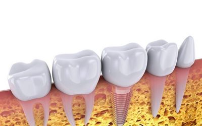 Dental Implants – Your Long-lived Permanent Tooth Replacement