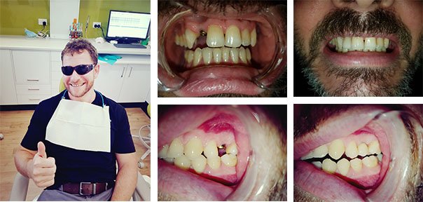 Dental Implants Placed andHappy Customer | Dentist Warner