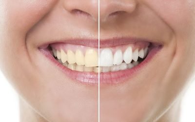 The Top Benefits of Professional Whitening