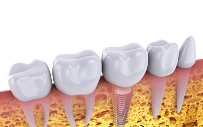 Dental Implants Explained: Step by Step Video