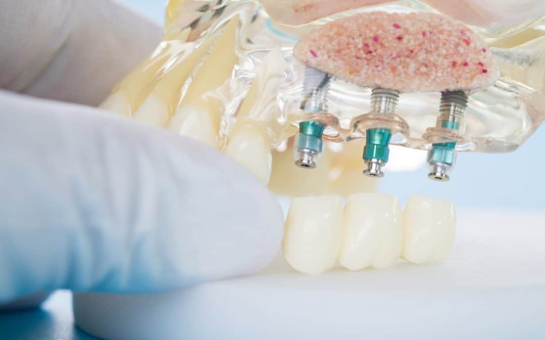 Dental Implants in Warner Lakes: Should You Shop Around?