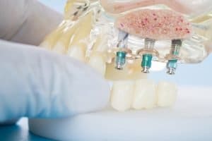 Dental Implants in Warner Lakes Should You Shop Around