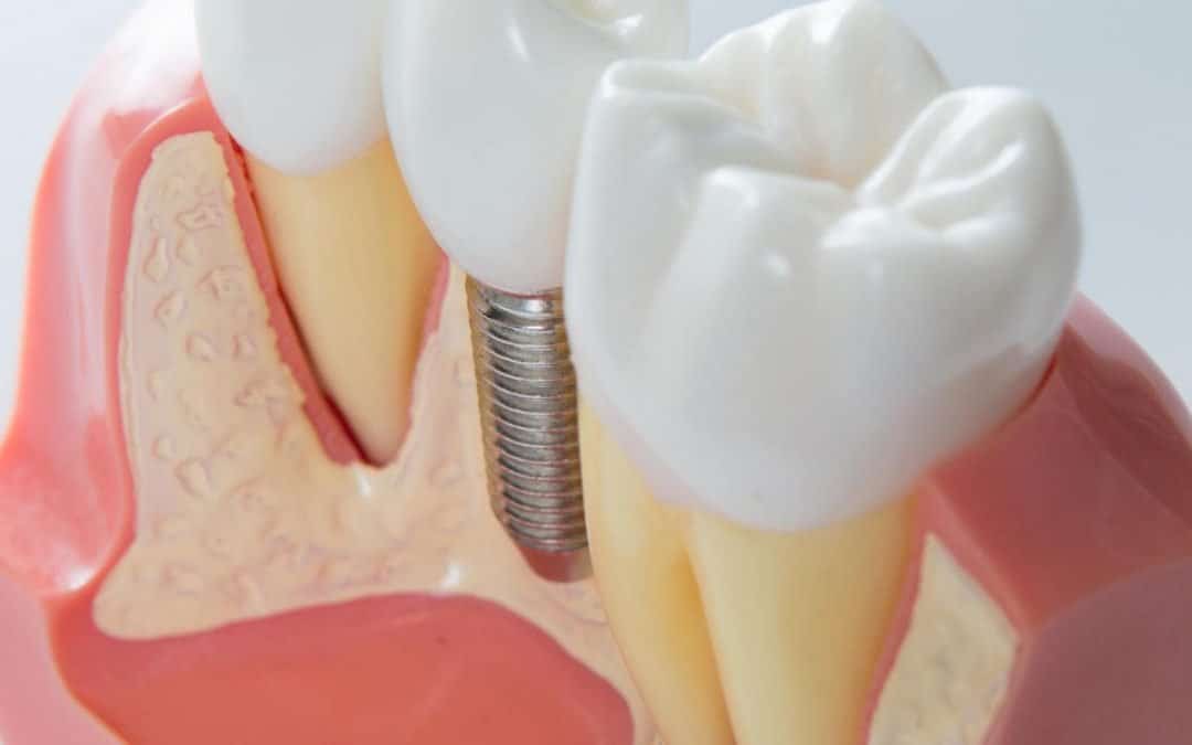 Dental Guide: Keep Your Dental Implants In Top Shape With These Important Tips