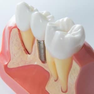 Keep Your Dental Implants In Top Shape With These Important Tips Dentist Warner