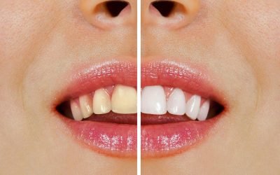 Your Ultimate Guide to Teeth Whitening in Warner Lakes