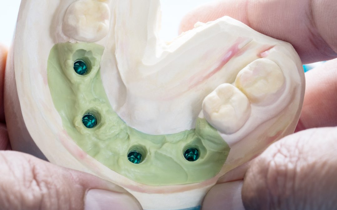 Warner Lakes Dental Answers: What are Supported-on-4 Dental Implants and When Do I Need Them?