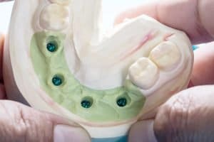 What are Supported-on-4 Dental Implants and When Do I Need Them