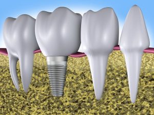 dental implants in aspley