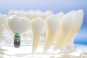 dental implants in bridgeman downs