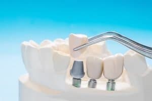 dental implants in carseldine