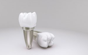 dental implants in north brisbane