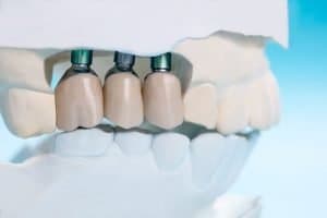 dental implants in south brisbane