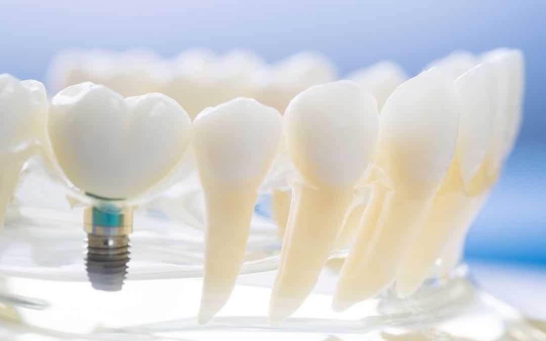 Getting Dental Implant Surgery? Here’s What to Expect
