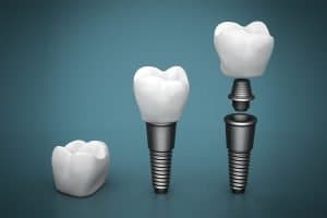 top 3 benefits of getting dental implants in warner brisbane