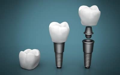 Top 3 Benefits of Getting Dental Implants in Warner Brisbane