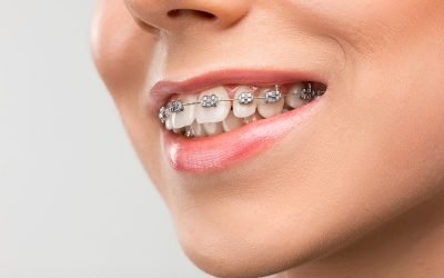 The Importance of Correcting your Overbite from Warner Lakes Dental