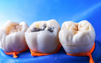 Choosing the Best Type of Dental Fillings in Warner