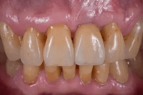 dental implant after dentist warner
