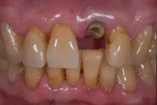 Dental implant before dentist warner