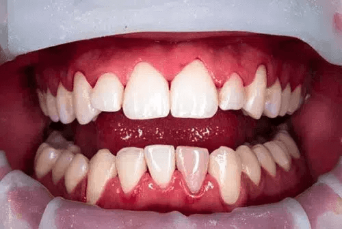 teeth cleaning after dentist warner