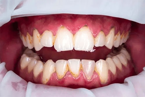 teeth cleaning before dentist warner