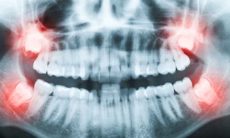 Wisdom Tooth Removal | Dentist Warner