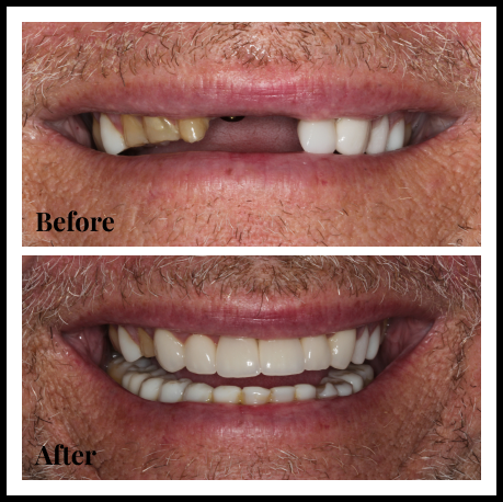 Porcelain Veneers Teeth