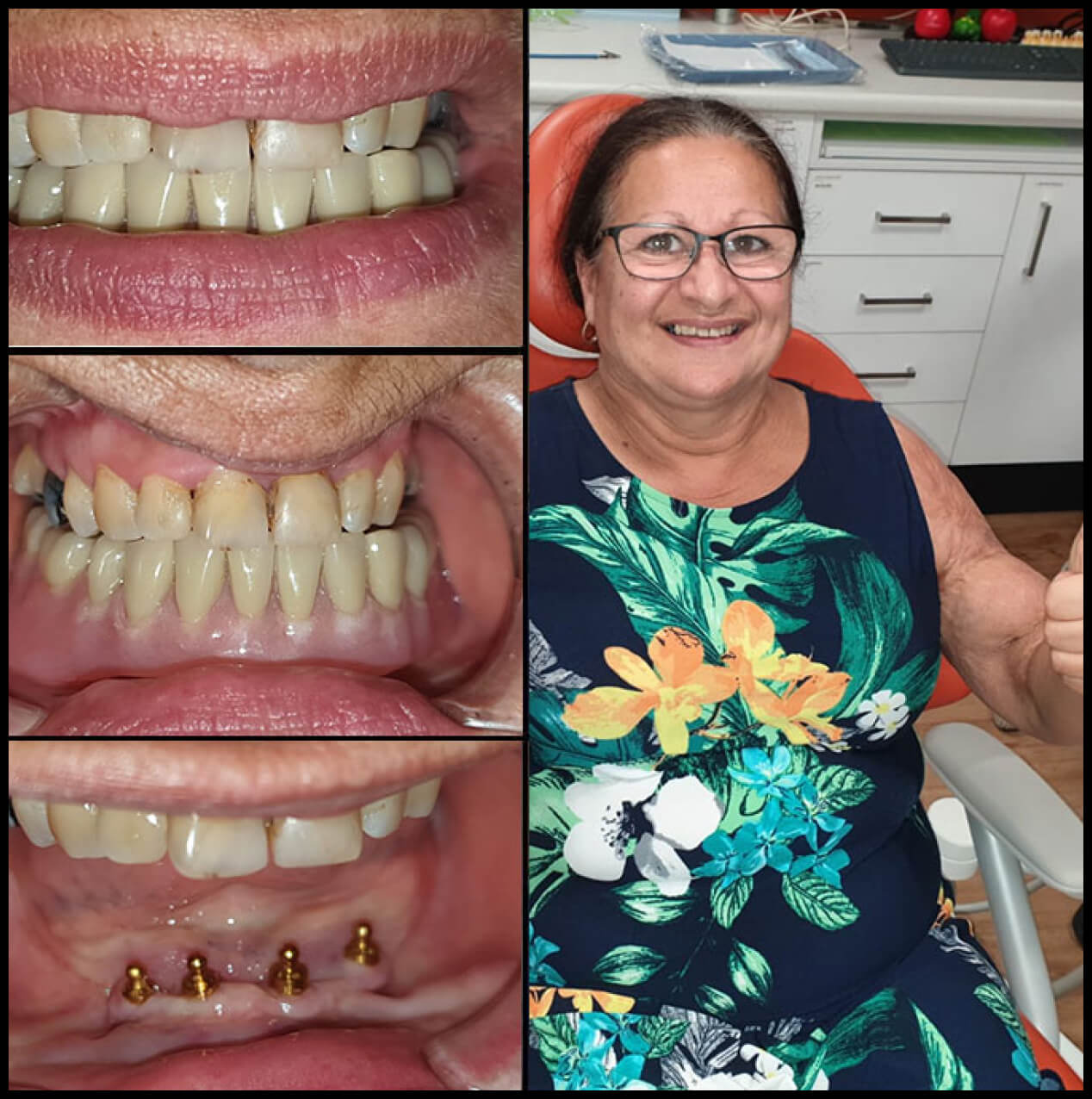 Dental Implant Process