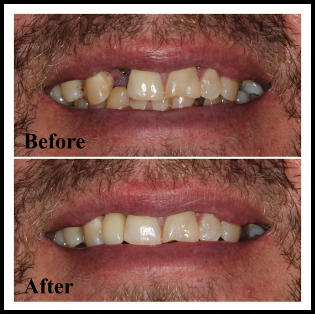 single-tooth-implant-brisbane-before-after